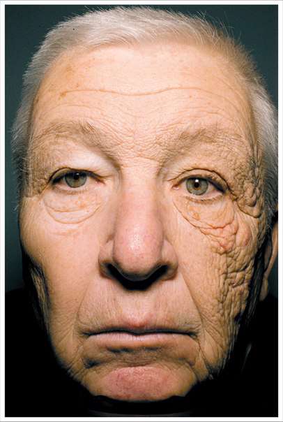 اثر تخریبی آفتاب بعد از 28 سال رانندگی روی پوست